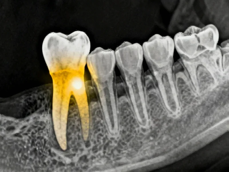 AI Breakthrough Automates Dental Disease Detection Using Advanced Object Recognition - Professional coverage